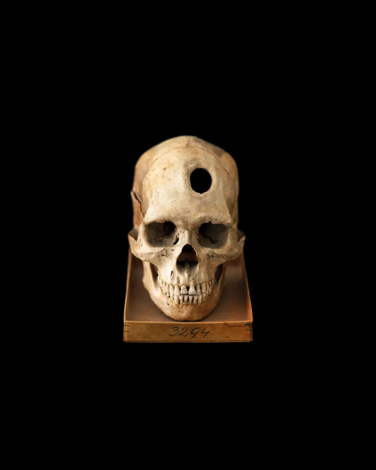 Trepanated skull of native of the Bismarck-Archipelago,
Melanesia, 1899. The rounding of the operation
hole indicates that the patient has survived for
years. Natural Historical Museum of Vienna, department
of Anthropology.