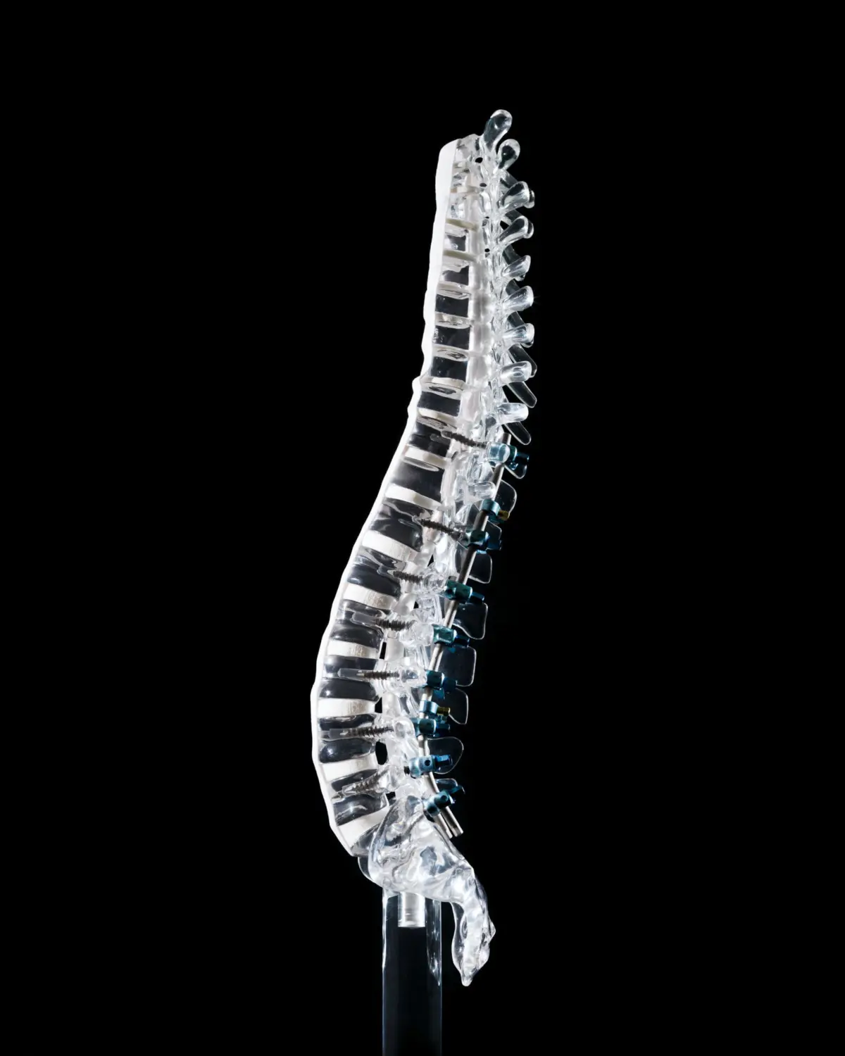 The CD Horizon® Legacy™ Spinal System can be used to treat scoliosis, a condition in which the spine develops one or more abnormal, side-to-side curves that in turn may affect the body’s overall balance and alignment. Medtronic, Inc.